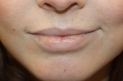 Lip Augmentation Before & After Patient #29304