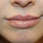 Lip Augmentation Before & After Patient #29304