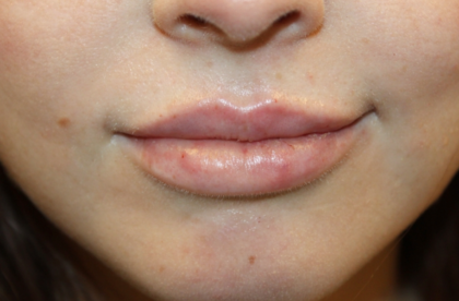 Lip Augmentation Before & After Patient #29304