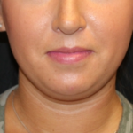 Kybella Before & After Patient #29312