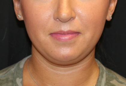 Kybella Before & After Patient #29312