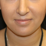 Kybella Before & After Patient #29312