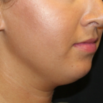 Kybella Before & After Patient #29312