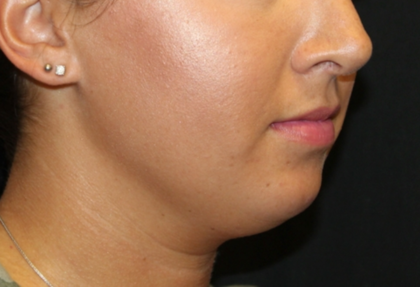 Kybella Before & After Patient #29312