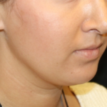 Kybella Before & After Patient #29312