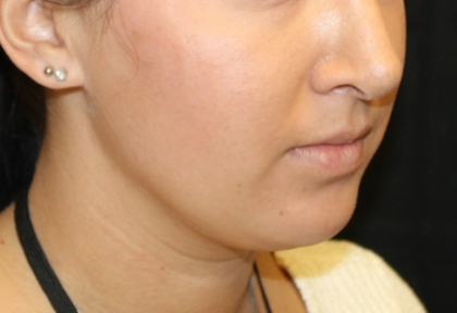 Kybella Before & After Patient #29312