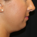 Kybella Before & After Patient #29312
