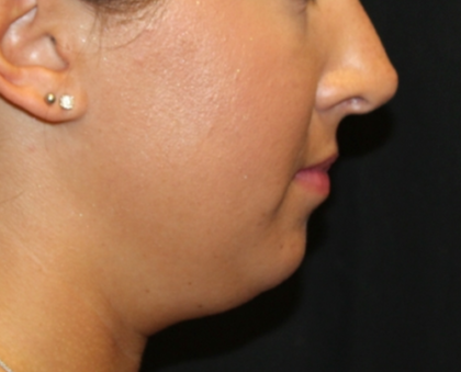 Kybella Before & After Patient #29312