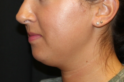 Kybella Before & After Patient #29312