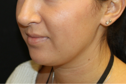 Kybella Before & After Patient #29312