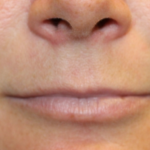 Lip Filler Before & After Patient #29323