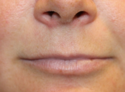 Lip Filler Before & After Patient #29323