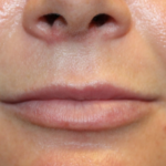 Lip Filler Before & After Patient #29323