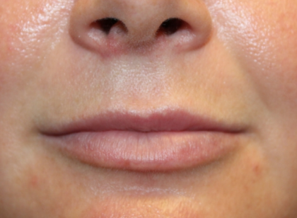 Lip Filler Before & After Patient #29323