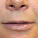 Lip Filler Before & After Patient #29323