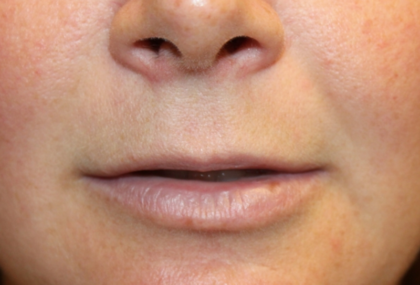 Lip Filler Before & After Patient #29323