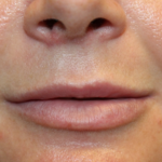 Lip Filler Before & After Patient #29323