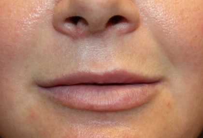 Lip Filler Before & After Patient #29323