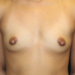 Breast Augmentation - Round Silicone Implants Before & After Patient #29166