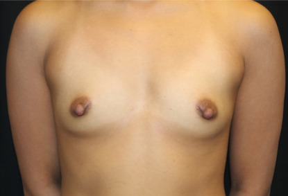 Breast Augmentation - Round Silicone Implants Before & After Patient #29166