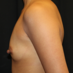 Breast Augmentation - Round Silicone Implants Before & After Patient #29166