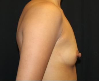 Breast Augmentation - Round Silicone Implants Before & After Patient #29166