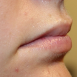 Lip Filler Before & After Patient #29368