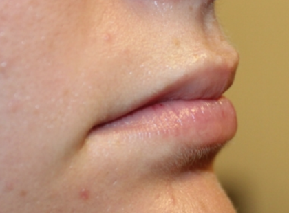 Lip Filler Before & After Patient #29368