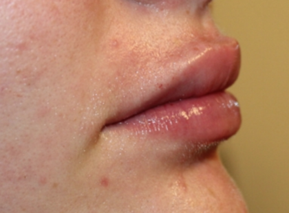 Lip Filler Before & After Patient #29368