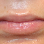 Lip Filler Before & After Patient #29368