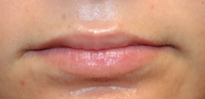 Lip Filler Before & After Patient #29368