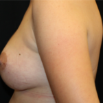 Breast Lift Before & After Patient #29418