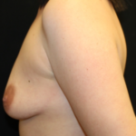 Breast Lift Before & After Patient #29418