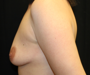 Breast Lift Before & After Patient #29418