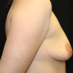 Breast Lift Before & After Patient #29418