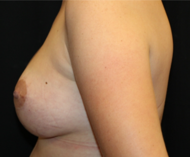 Breast Lift Before & After Patient #29418