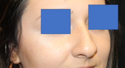 Rhinoplasty Before & After Patient #29423