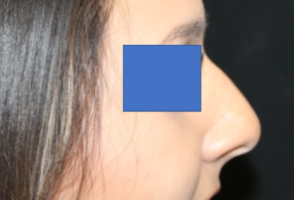 Rhinoplasty Before & After Patient #29423