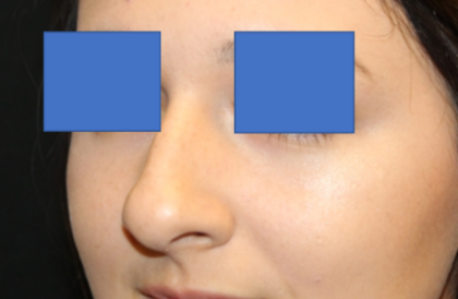 Rhinoplasty Before & After Patient #29423