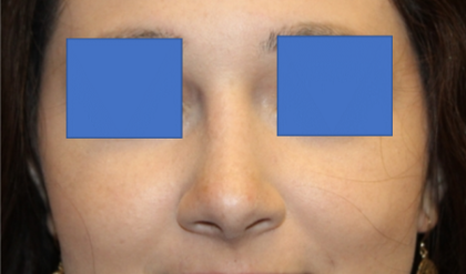 Rhinoplasty Before & After Patient #29423