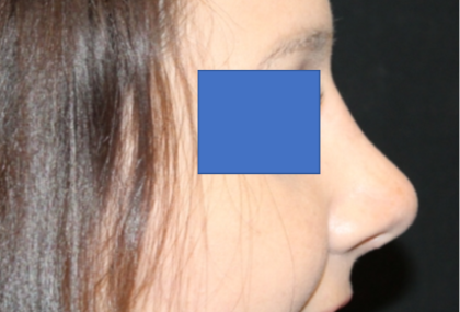 Rhinoplasty Before & After Patient #29423