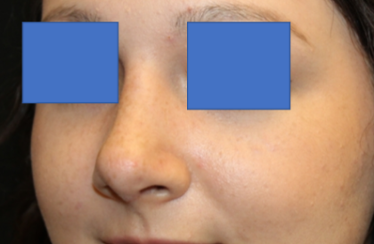 Rhinoplasty Before & After Patient #29423