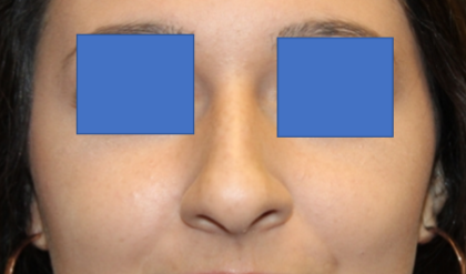 Rhinoplasty Before & After Patient #29423