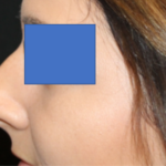Rhinoplasty Before & After Patient #29423