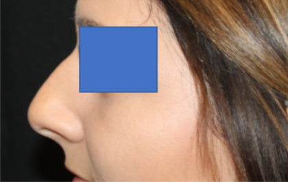 Rhinoplasty Before & After Patient #29423