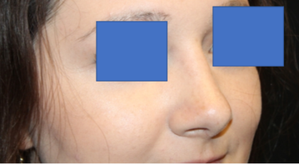 Rhinoplasty Before & After Patient #29423