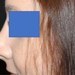 Rhinoplasty Before & After Patient #29423