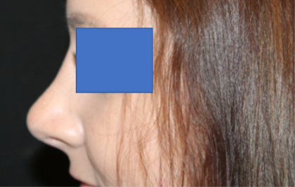 Rhinoplasty Before & After Patient #29423