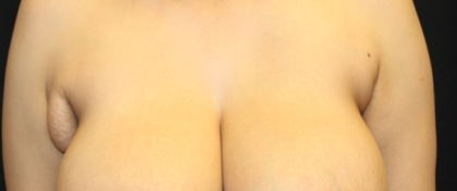 Axillary Breast Tissue – Removal Before & After Patient #29396