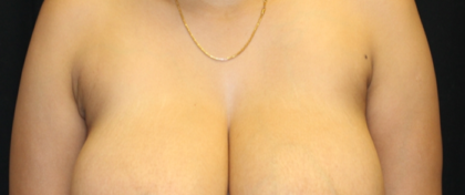Axillary Breast Tissue – Removal Before & After Patient #29396